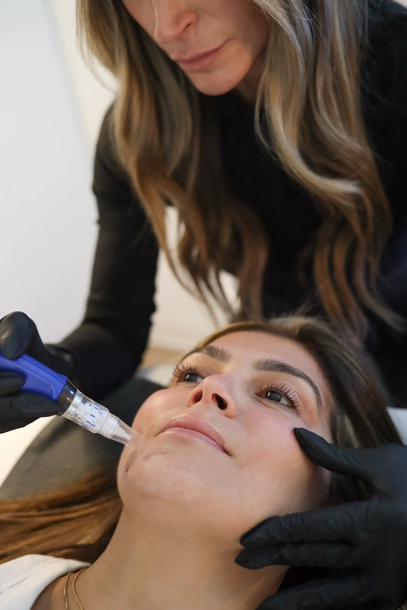 A patient receives microneedling in Ashburn, VA.