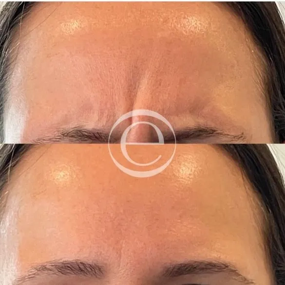 Botox before and after &mdash; glabella lines