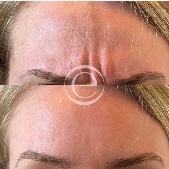 Botox before and after &mdash; forehead & glabella