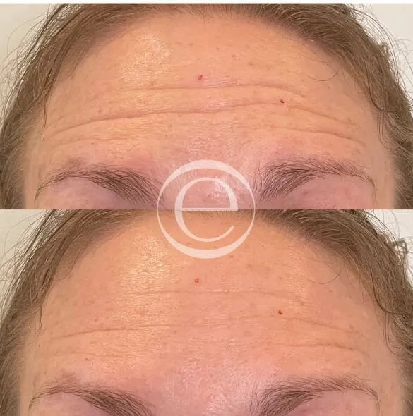Botox before and after &mdash; forehead lines