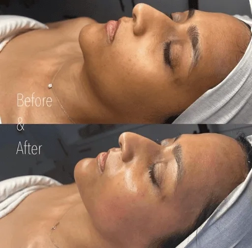 Hydrafacial before and after results at Envi Aesthetics