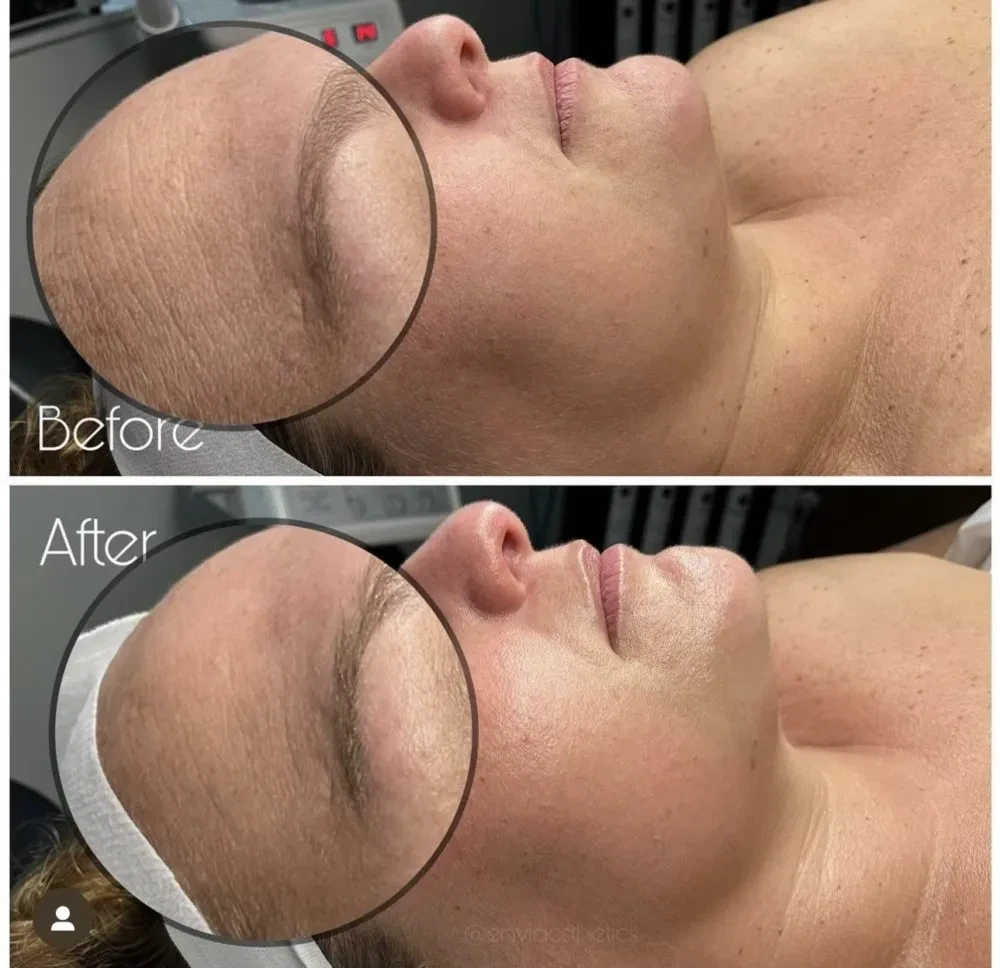 Hydrafacial before and after results at Envi Aesthetics
