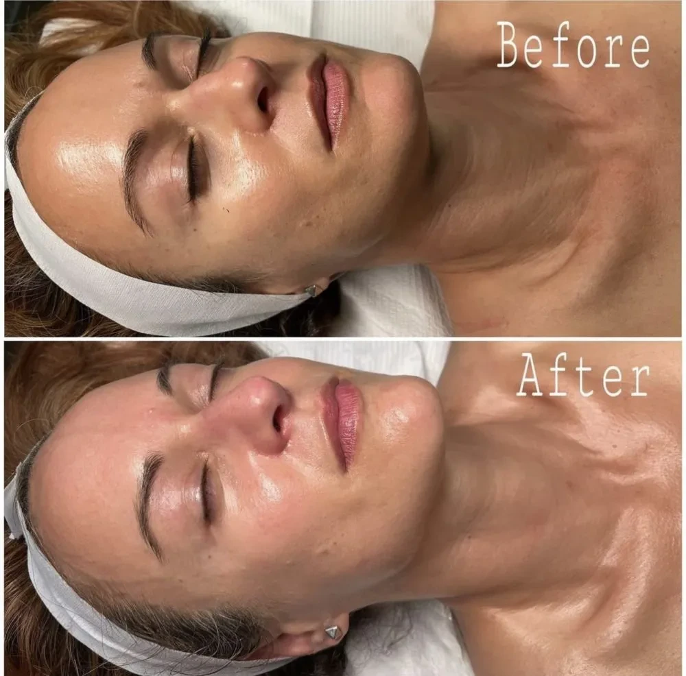 Hydrafacial before and after results at Envi Aesthetics